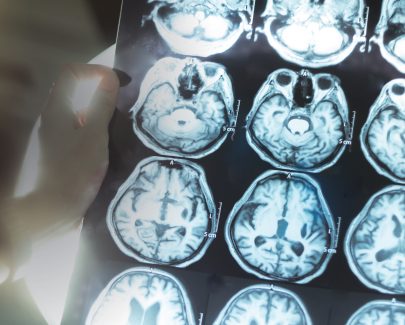 Neurodegenerative conditions