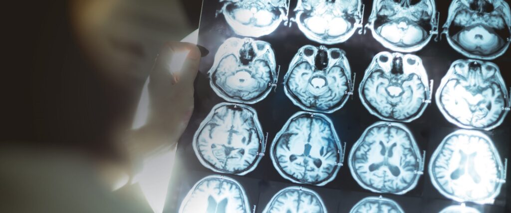 Neurodegenerative conditions|||||